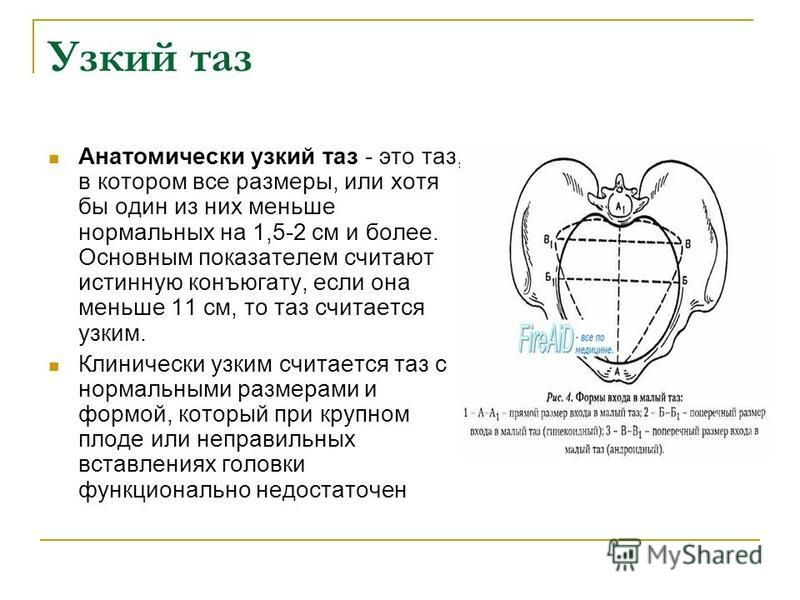 Какой таз лучше. Анатомически узкий таз степени. Узкий таз при беременности. Размер таза при беременности норма. Акушерская патология узкий таз.