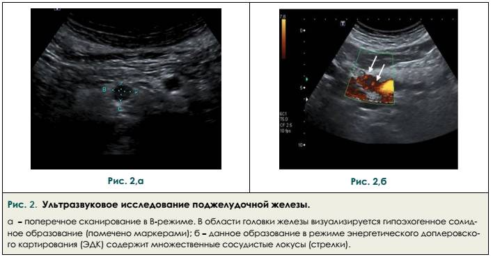 Узи поджелудочной железы фото узи