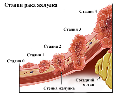 Стадии развития рака желудка (рисунок)