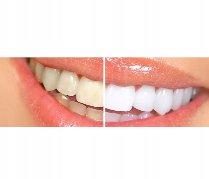 отбеливание зубов отзывы форум стоматологов