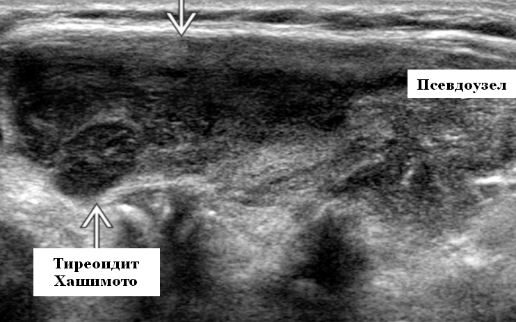 Уз картина. АИТ на УЗИ щитовидной железы. Фиброзный тиреоидит Риделя. Подострый тиреоидит де Кервена на УЗИ. Тиреоидит щитовидной железы на УЗИ.