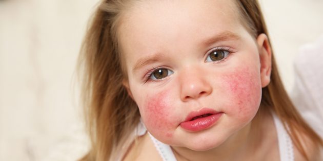 Сыпь на лице: пищевая аллергия