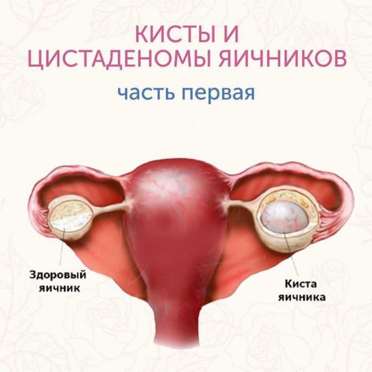 Лечение яичника у мужчин. Киста яичников симптомы. Симптомы кистей на яичниках. Киста на яйчника симптоми.