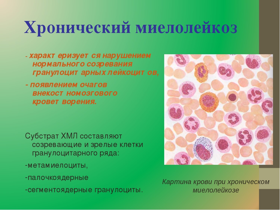 Лейкоз характеризуется. Хронический миелоидный лейкоз характеризуется. Хронический миелоидный лейкоз кровь. Хронический миелолейкоз картина крови. Хр миелолейкоз картина крови.
