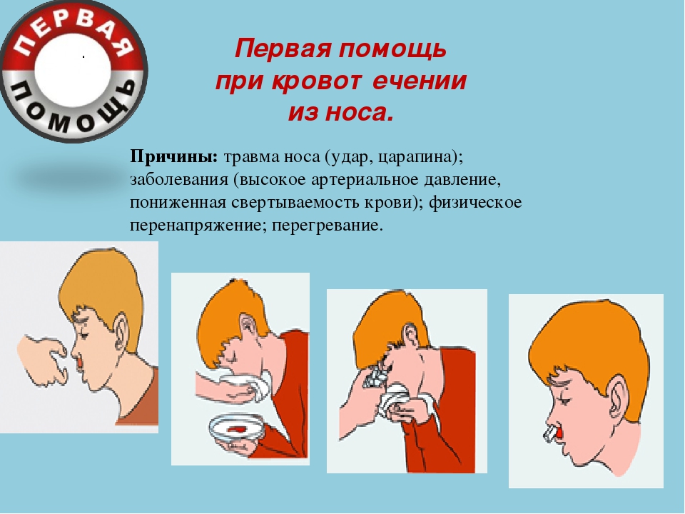При носовом кровотечении нужно. Первая помощь при кровотечении из носа. Оказание помощи при кровотечении из носа. При кровотечении из носа. Оказание первой помощи при травме носа.