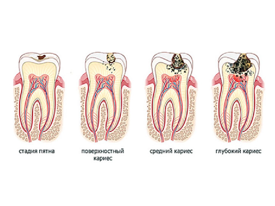 Заболевания зубов и полости. Заболевания зубов кариес пульпит периодонтит. Кариес эмали кариозное. Степени развития кариеса. Кариес биология 8 класс.