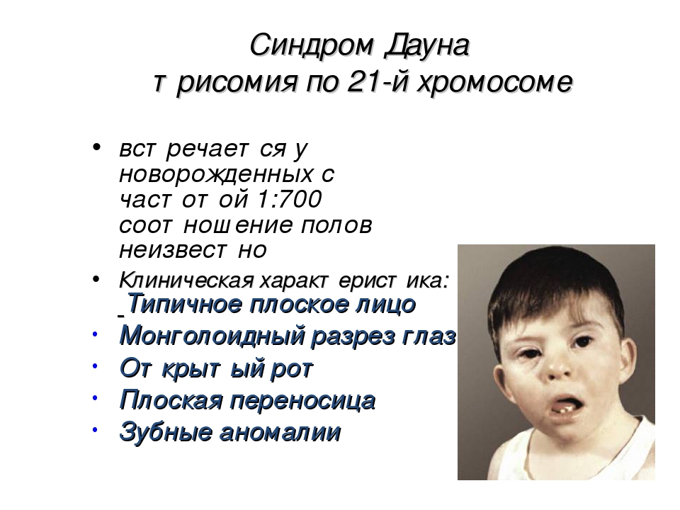 План дауна. Синдром Дауна. Признаки синдрома Дауна у новорожденного. Признаки синдромома Дауна. Новорожденный с синдромом Дауна.