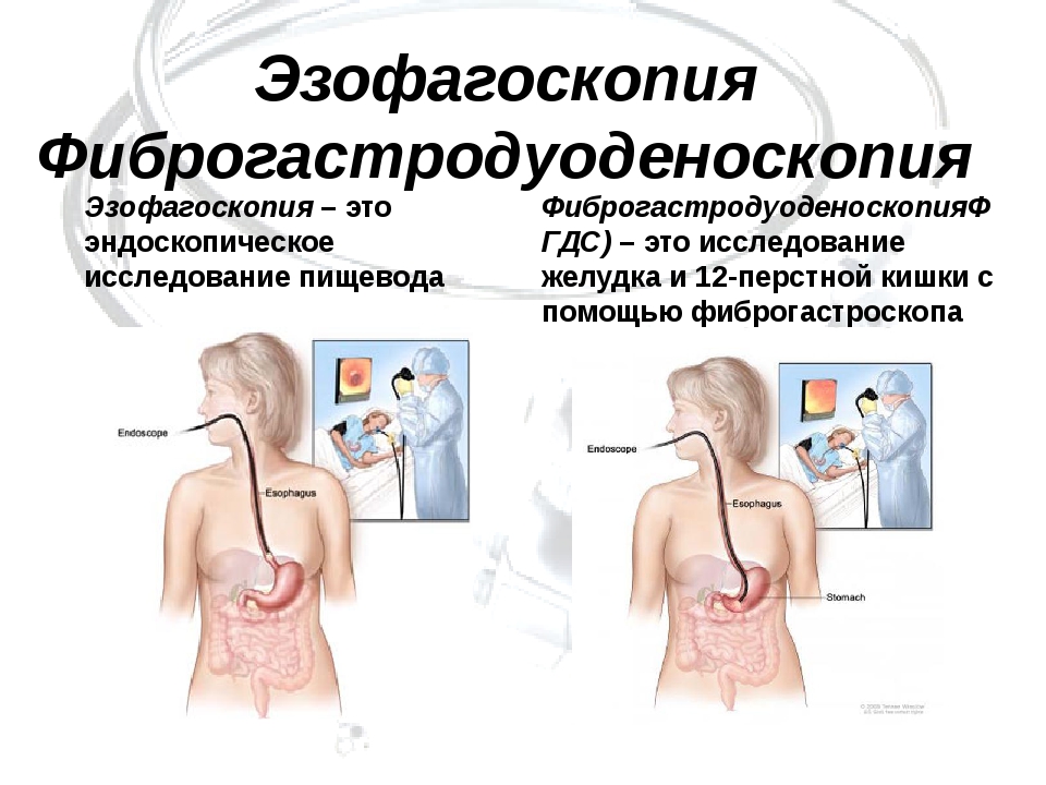 Подготовка к фгдс желудка взрослого. Эзофагоскопия это исследование. Эзофагоскопия подготовка пациента. ФГДС исследование.