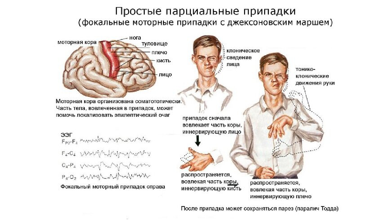 Симптомы эпилепсии у мужчин