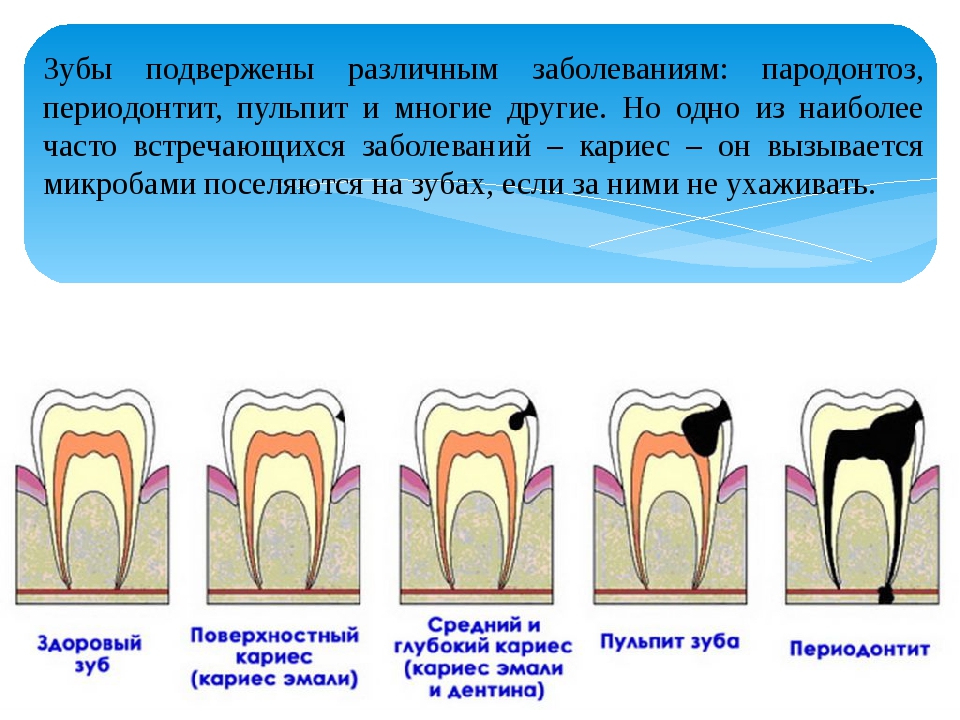 Периодонтит и пульпит разница