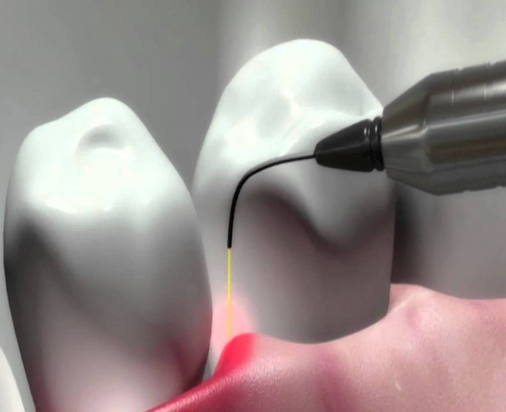 Лазерное десен. Лазеротерапия в стоматологии. Диодный лазер в стоматологии. Терапевтический лазер в стоматологии.