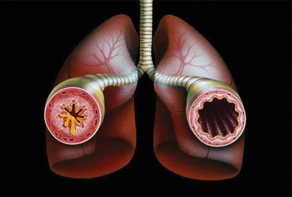 астма причины возникновения