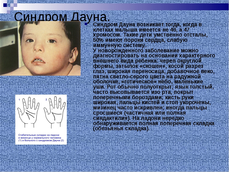 Заболевание болезнь дауна. Синдром Дауна. Младенцы с синдромом Дауна. Формы синдрома Дауна.