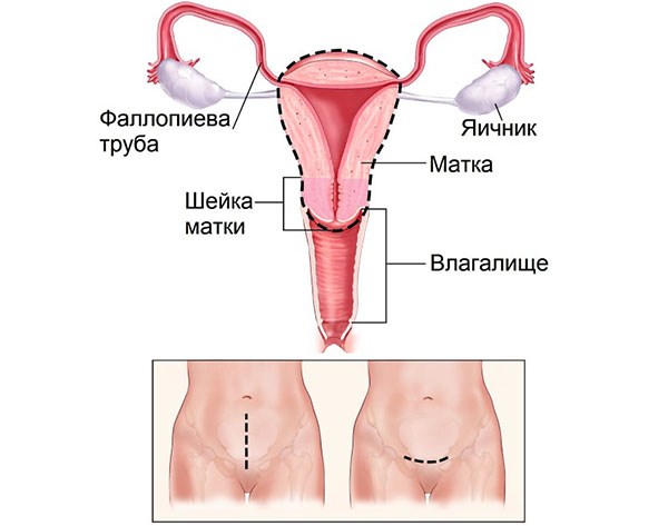 Лечение фибромы матки