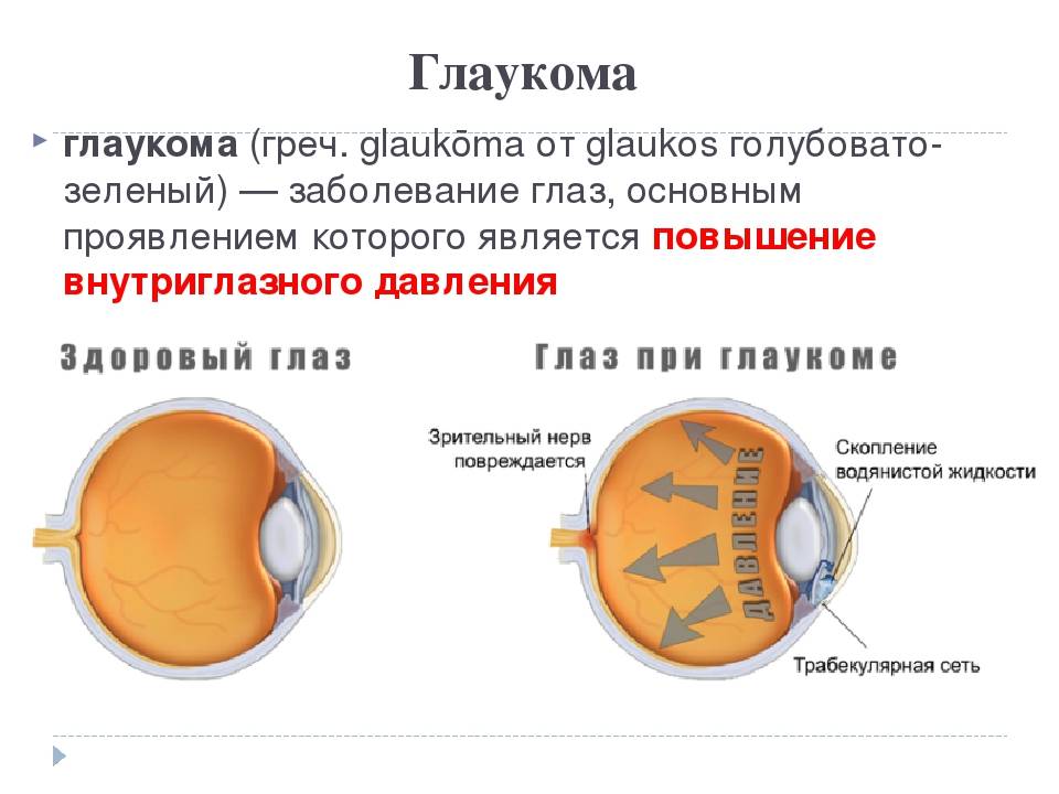 Давление в глазах симптомы. Заболевание глаз глаукома. Глаукома схема глаза.