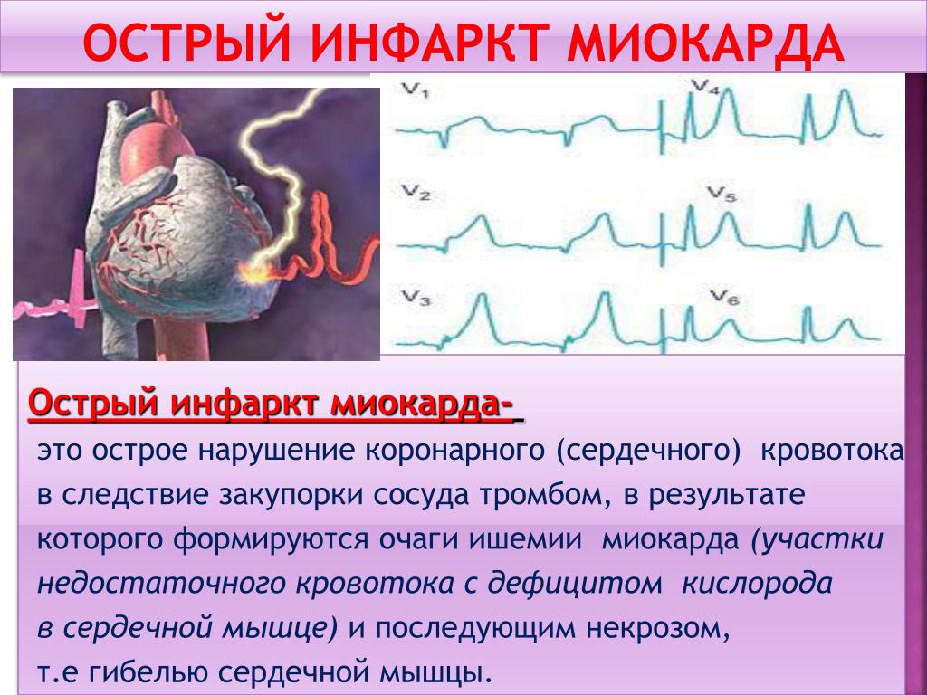 Инфаркт миокарда обусловлен