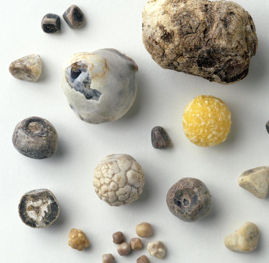 Камни желчь пузыря. Билирубиновые (пигментные) камни.