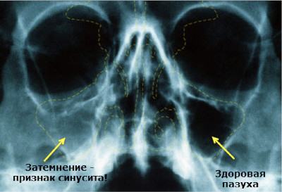 Рентеновский снимок с наличием синусита - гайморита