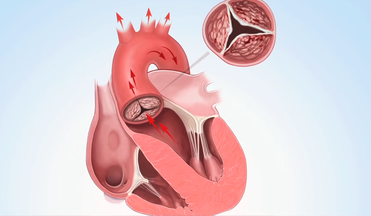 Митральный аортальный стеноз. Сенильный аортальный стеноз. Стеноз аортального клапана. Ревматический митральный порок сердца. Порок сердца стеноз аортального клапана.