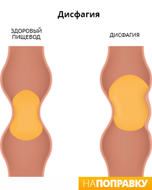 Пищевод при дисфагии (схема)