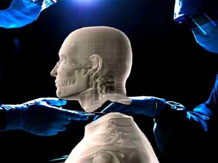 Можно ли пересадить мозги. Итальянский нейрохирург Серджио Канаверо. Серджио Канаверо голова человека. Серджио Канаверо пересадка головы. Трансплантация человеческой головы.