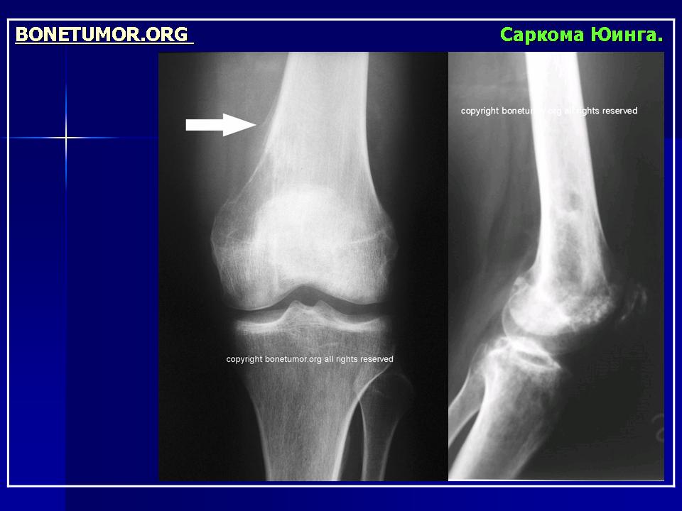 Саркомы костей нмо. Остеосаркома бедренной кости рентген. Остеогенная саркома рентген. Опухоль Юинга рентгенологическая картина. Остеогенная саркома бедренной кости кт.