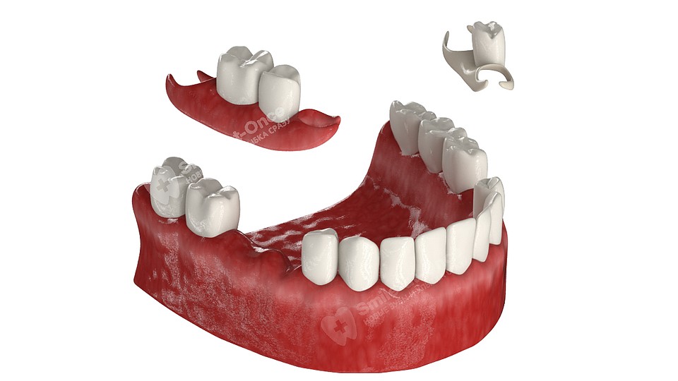 Съемный протез «бабочка» замещает всего пару зубов, но держится довольно плохо. 