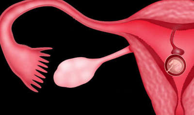 Можно ли забеременеть после удаления полипа эндометрия