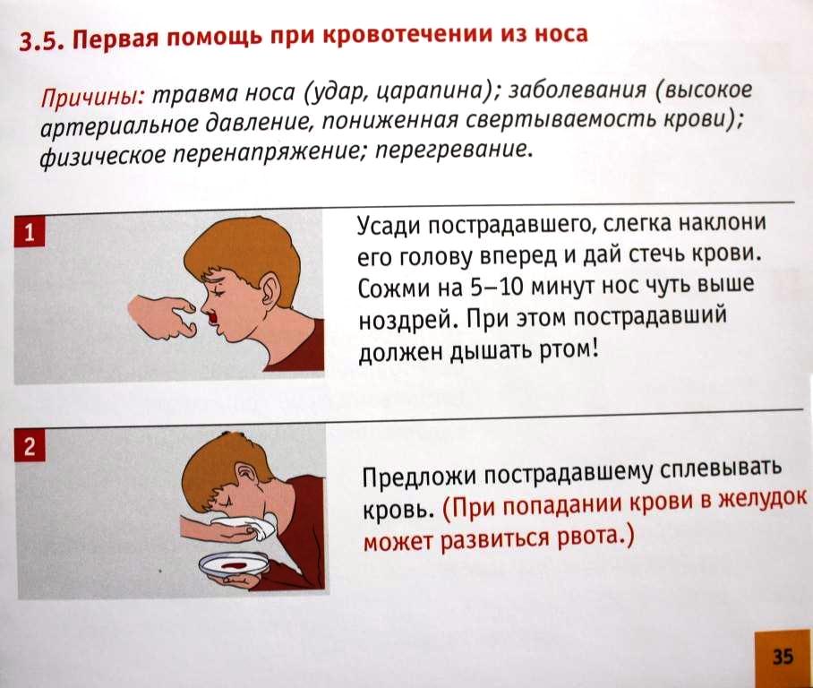 Ребенок 5 лет идет кровь из носа. При кровотечении из носа. Носовое кровотечение у ребенка карта вызова. Положение при носовом кровотечении.