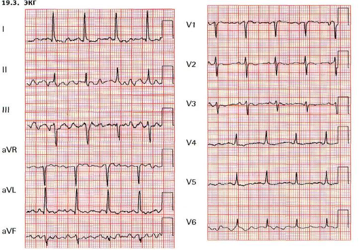 Патологии на экг фото с расшифровкой примеры
