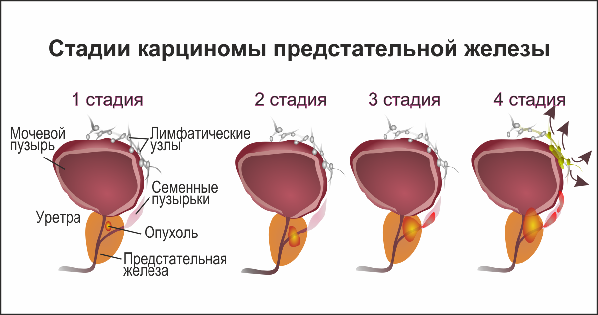 Онкологии предстательной железы у мужчин. Злокачественная опухоль предстательной железы. Стадии предстательной железы. Опухоль предстательной железы стадии. Аденома предстательной железы классификация.