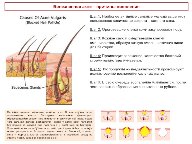 Почему протоки сальных желез впадают в волосяную. Сальные железы выделяют кожное сало. Сальные железы Тип железы 1.