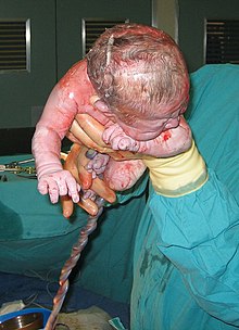 Caesarian section - Pull out.jpg