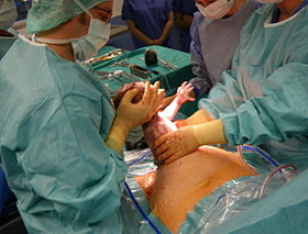 Caesarian section - Pull out.jpg