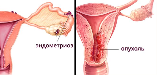Симптомы эндометриоза. Хронический эндометриоз. Эндометриоз патология эндометрия.