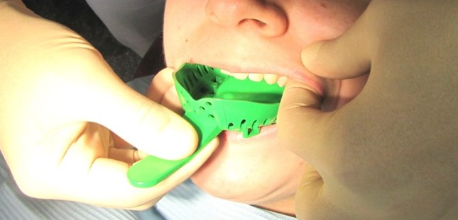 На этапе снятия оттисков зубов