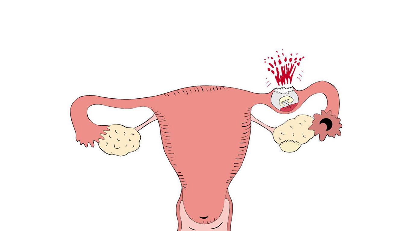 Маточные трубы удаление месячные. Внематочная беременность Трубная беременность. Эктопическая Трубная беременность. Внематочная беременность разрыв маточной трубы. Внематочная беременность рисунок.