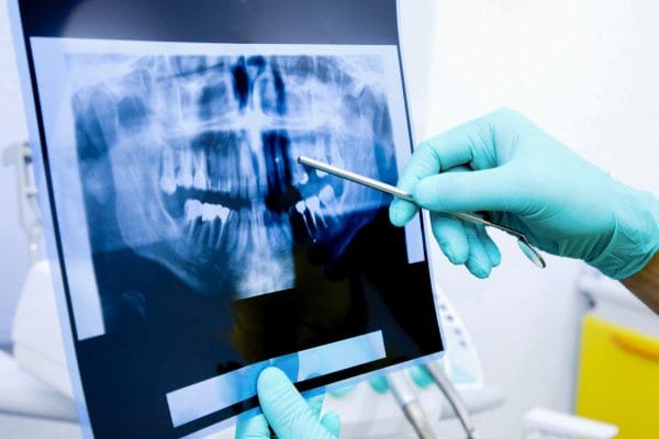 Рентгеновские снимки являются обязательным элементом эндодонтического лечения