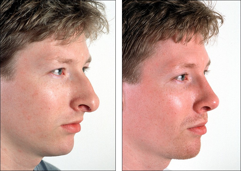 Красный нос у мужчины. Ринопластика носа мужчины до и после. Ринопластика до и после мужчины.