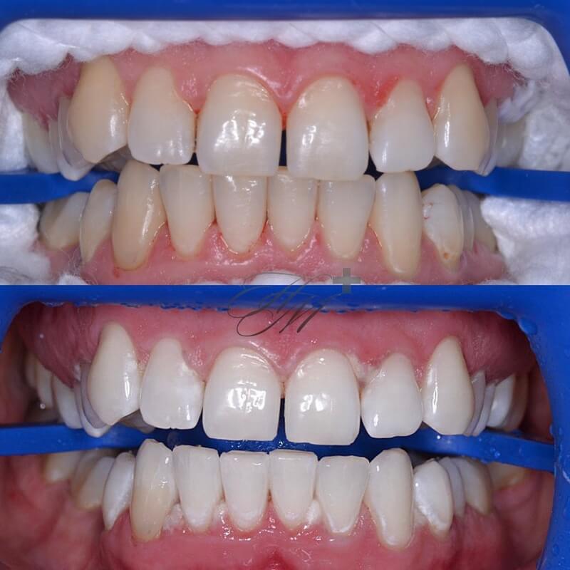 Осложнения после отбеливания зубов ирригатор и щетка в комплекте