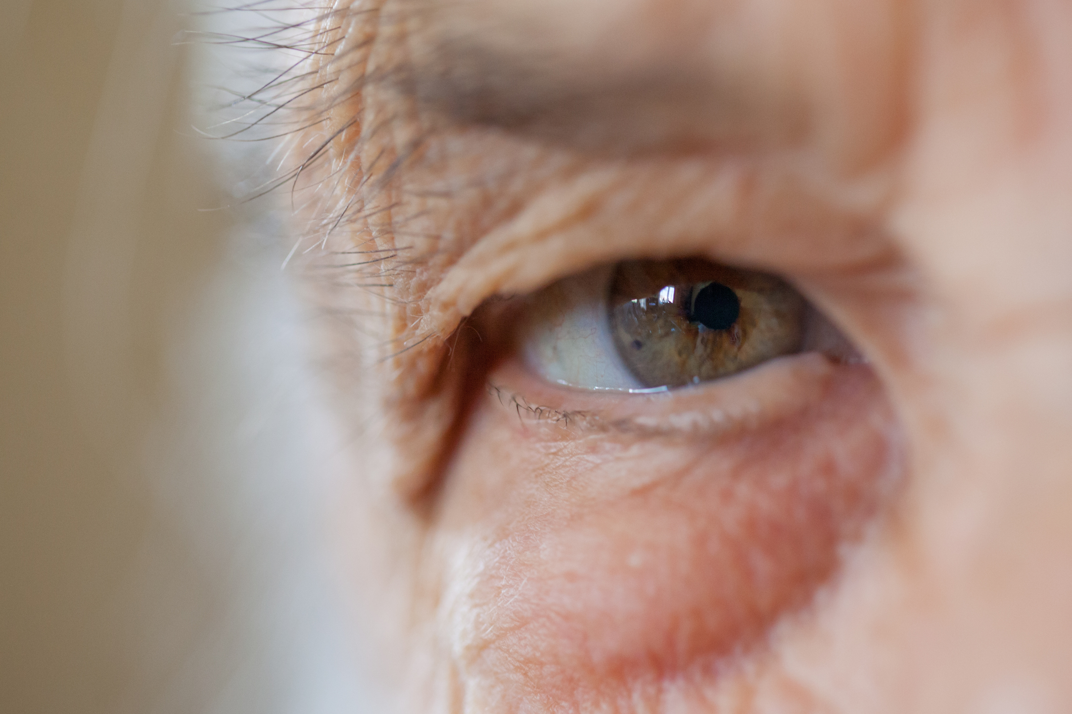 Глазное давление при катаракте. Глаукома фото начальная стадия.
