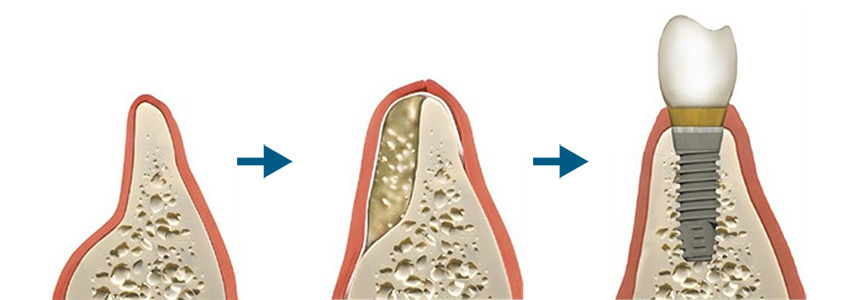 Восстановление костной ткани зубов. Остеопластика костной ткани. Костная пластика (остеопластика). Костная ткань при имплантации зубов. Костная мембрана в стоматологии.