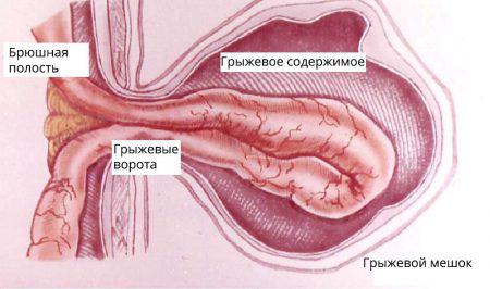 Анатомическая структура грыжи