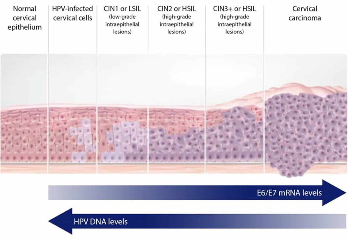 Дисплазия шейки матки что это такое. Дисплазия шейки матки Cin 1. Дисплазия шейки матки LSIL. Cin 1. Дисплазия шейки матки HSIL что это такое.