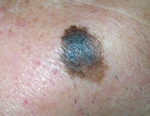 Рак кожи: симптомы, диагностика и лечение